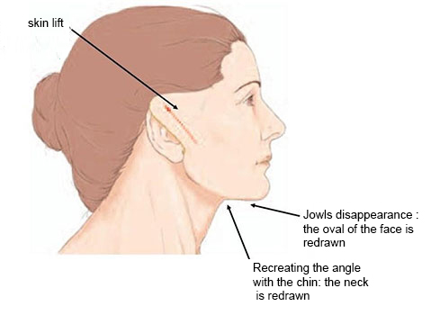 face neck lift abroad